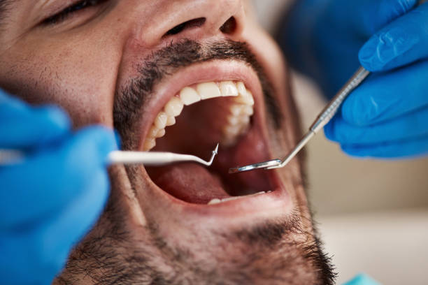 Best Emergency Wisdom Teeth Removal in Battle Ground, WA